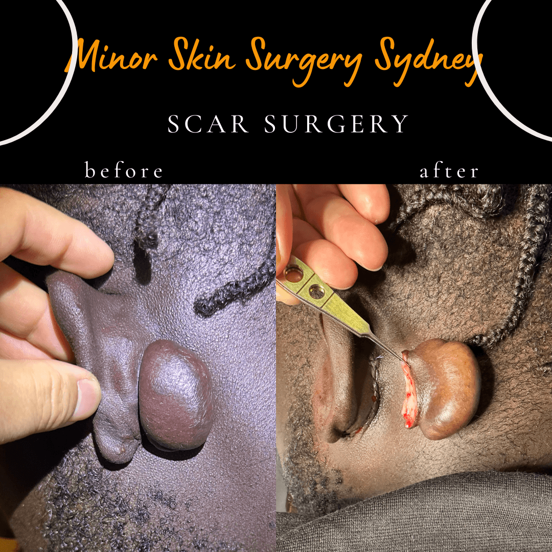 Before and after surgical removal of a raised scar performed under local anaesthesia by Dr Peter Kim. Keloid scar treatment
