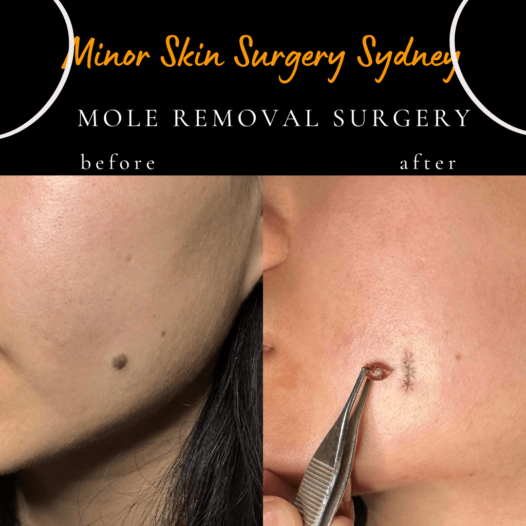 Facial mole removal via surgical excision under local anaesthesia with same-day consultation and pathology testing options by Dr Peter Kim.