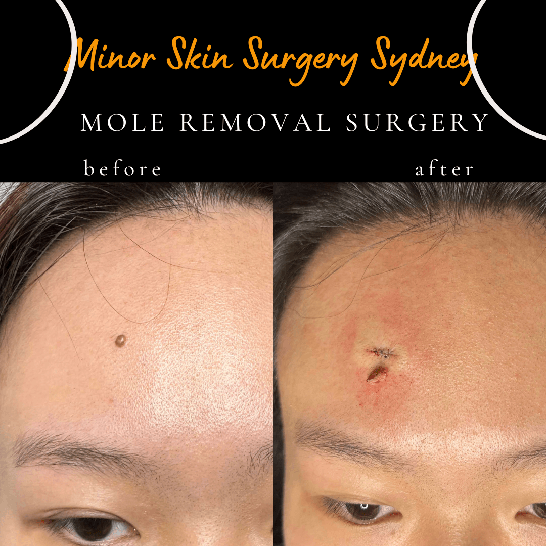 Surgical mole removal under local anaesthesia with same-day consultation and pathology testing options at Cosmetic Laser Sydney.