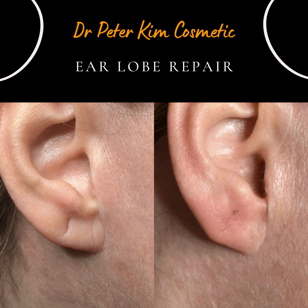 Before and one-week-after photos of surgical repair of a loose, stretched earring hole performed under local anaesthesia by Dr Peter Kim.