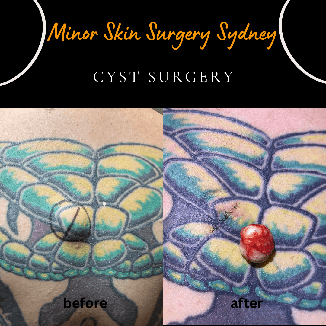 Complete surgical excision of a large groin cyst under local anaesthesia performed as a same-day service by Dr Peter Kim.