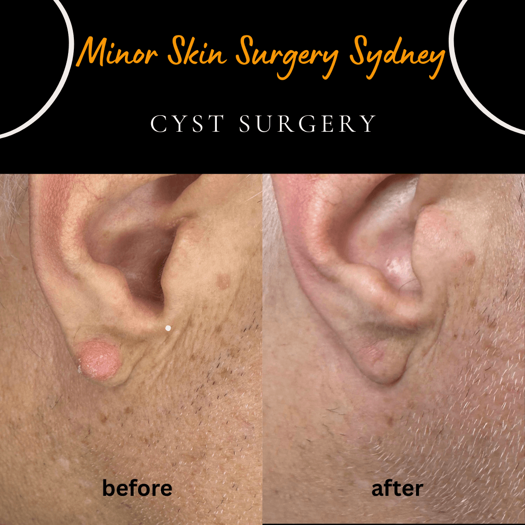 Rare 12-month before and after photo showing scar healing following cyst surgery, performed by Dr Peter Kim.