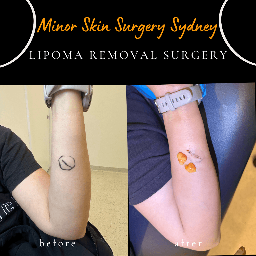 Removal of two lipomas found during the same surgical procedure, performed under local anaesthesia by Dr Peter Kim.