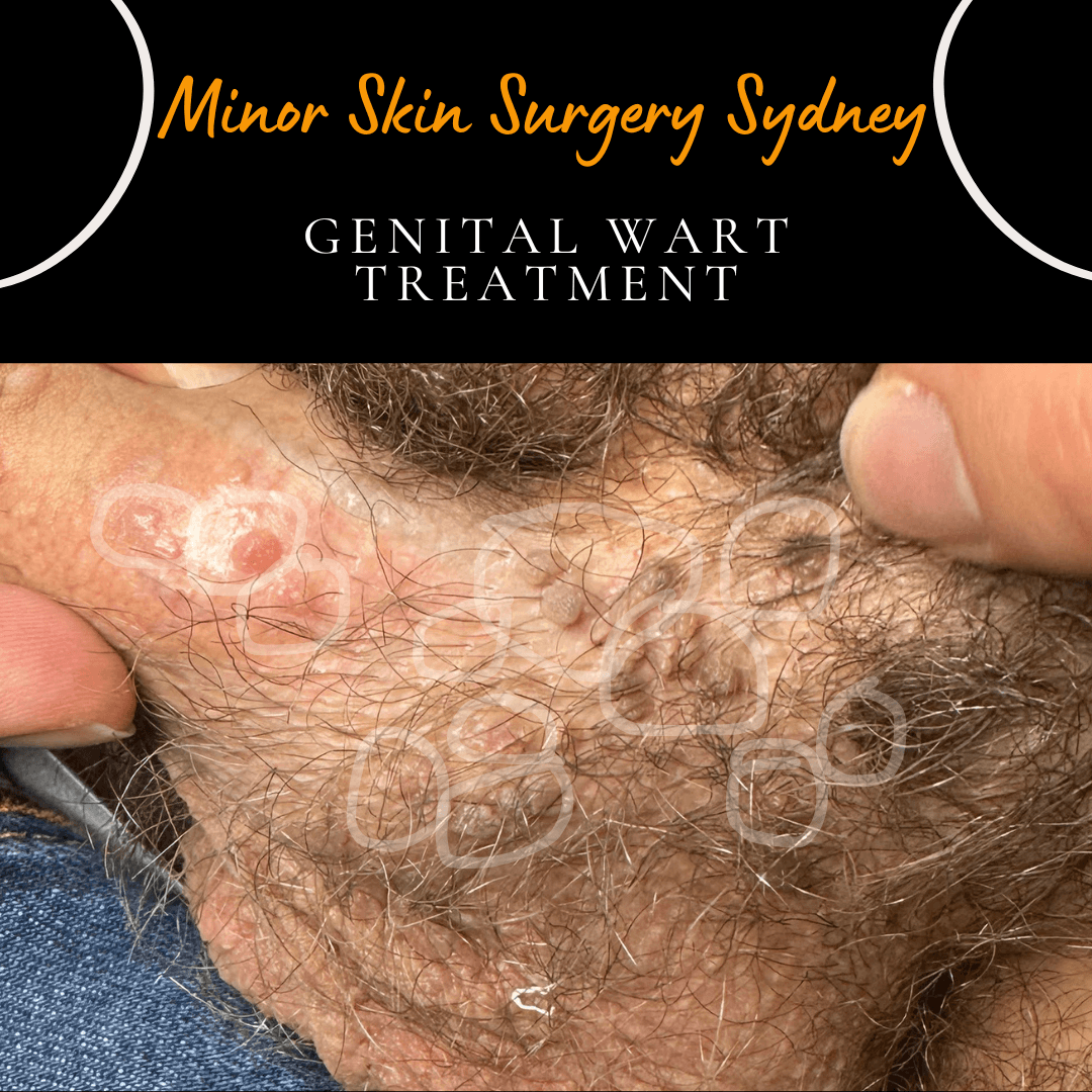 This patient had been treated for genital warts by a dermatologist for the past several years before coming to me. Why are there so many warts after so many treatments? We treated this patient with our laser genital wart treatment in a single session. With so many warts, they generally need two sessions.