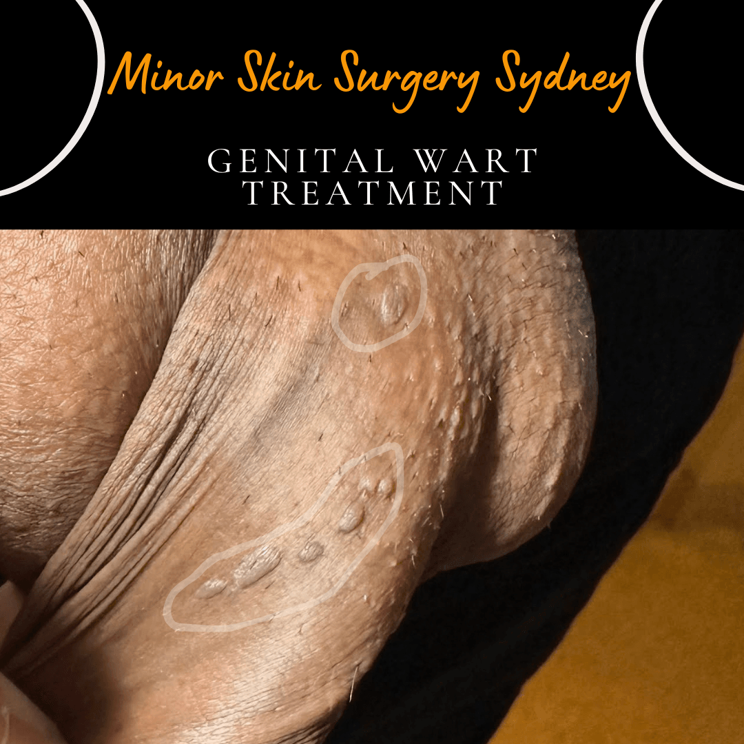 Laser genital wart removal targeting the root cause for minimal recurrence, compared to over-the-counter treatments, performed by Dr Peter Kim.