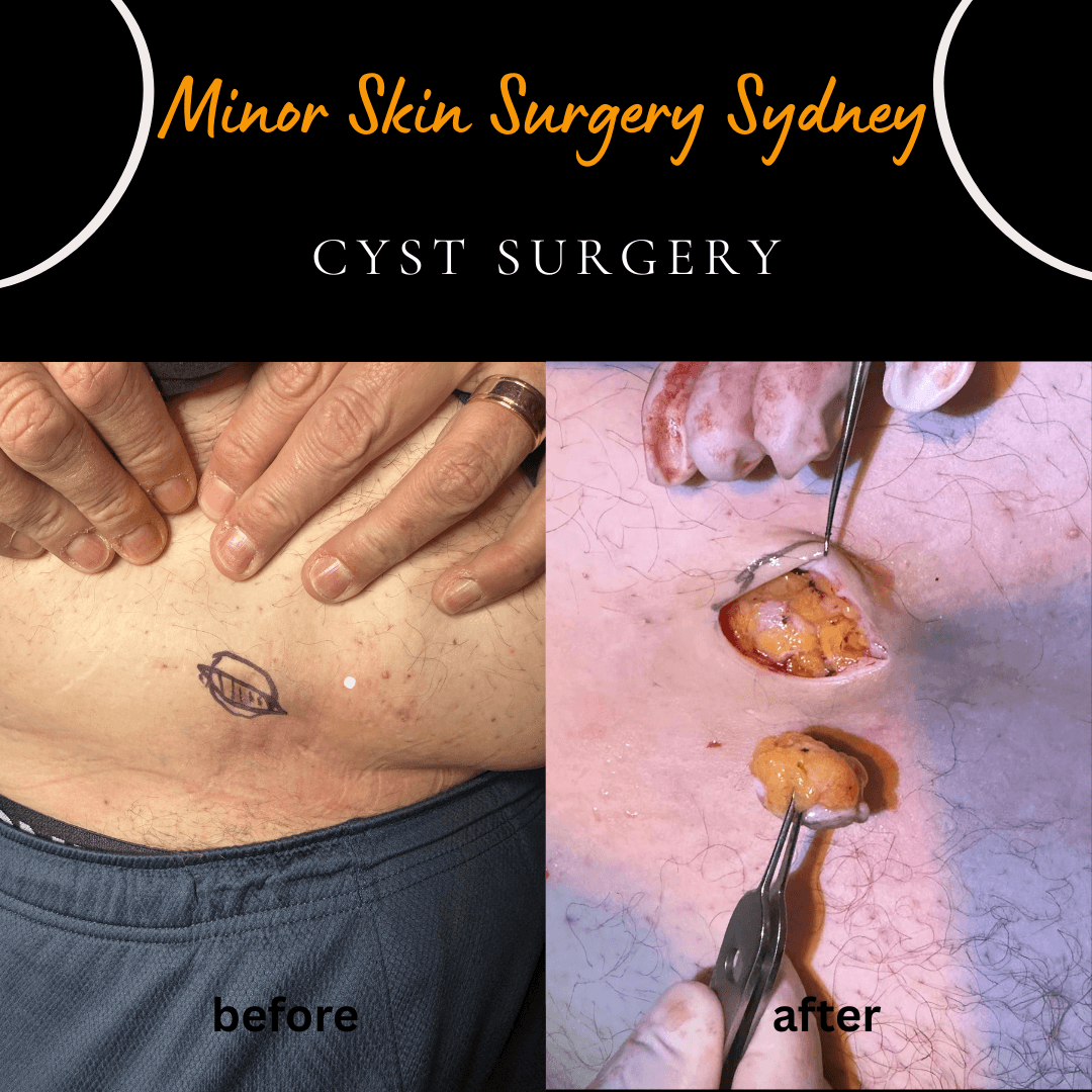 Complete surgical excision of a recurrent lower abdominal cyst under local anaesthesia to prevent further recurrence, performed by Dr Peter Kim.