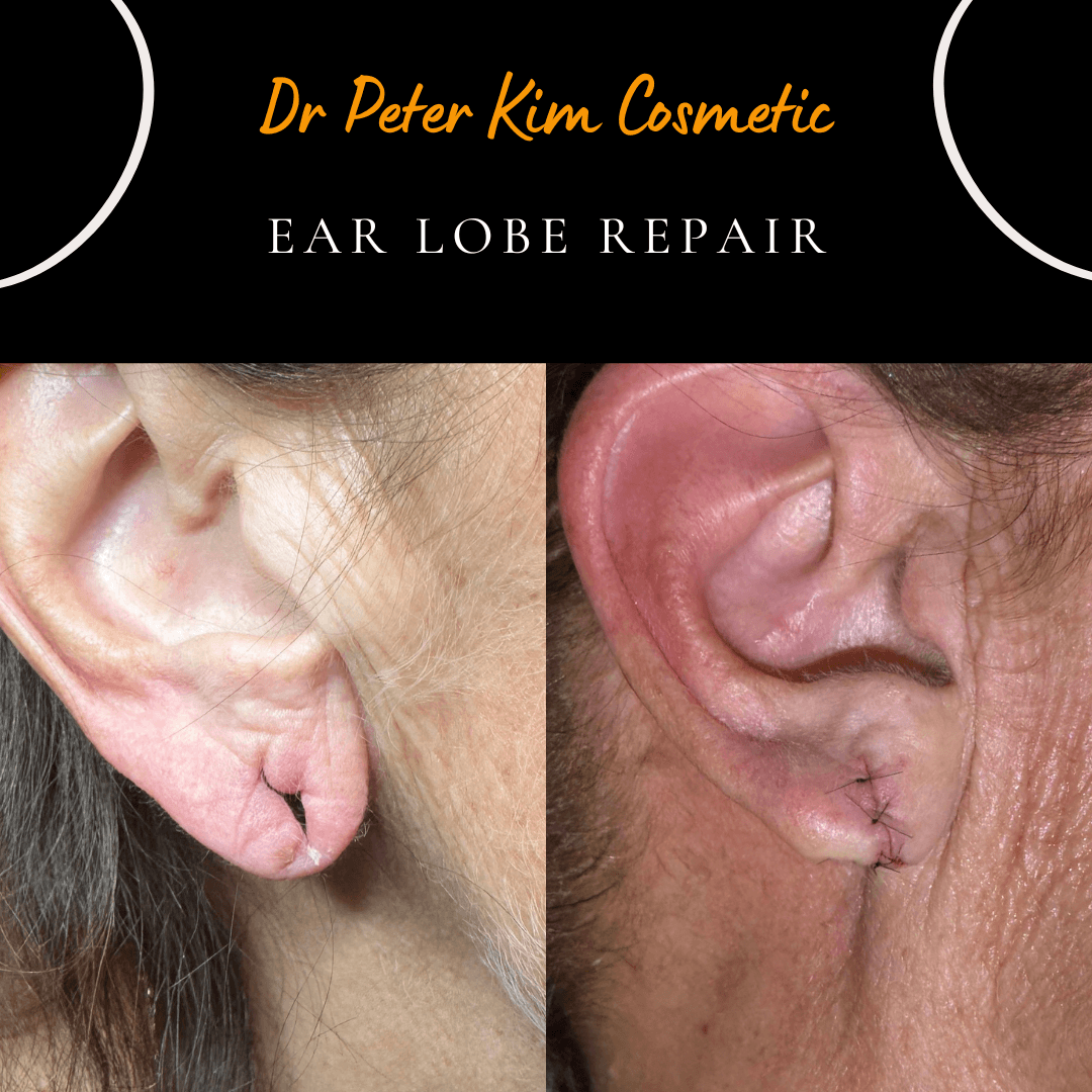 A torn earlobe doesn't always heal permanently the first time, especially if it's re-injured before it's fully settled.

This patient's earlobe had originally torn due to an earring accident and was repaired, but unfortunately tore again afterward. We offered a same-day repeat repair of the torn earlobe under local anaesthesia, giving her a prompt solution without a long wait for a second procedure.

Recurrent tears can happen, particularly if the area is knocked or put under strain again before the tissue has fully healed, but a further repair can generally be carried out successfully.

All consultations and procedures are personally performed by Dr Peter Kim.

📞 Book a consultation
(02) 9411 4880
0433 284 880
📍 Chatswood, Cabramatta & Ryde, Sydney