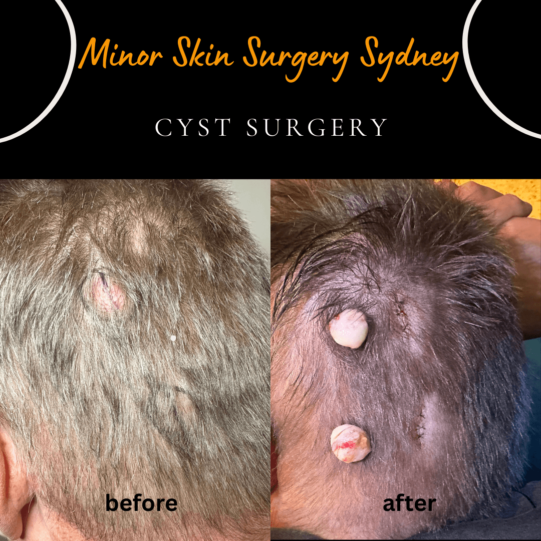 Same-day surgical removal of two cysts performed together under local anaesthesia, a safe and affordable option by Dr Peter Kim.