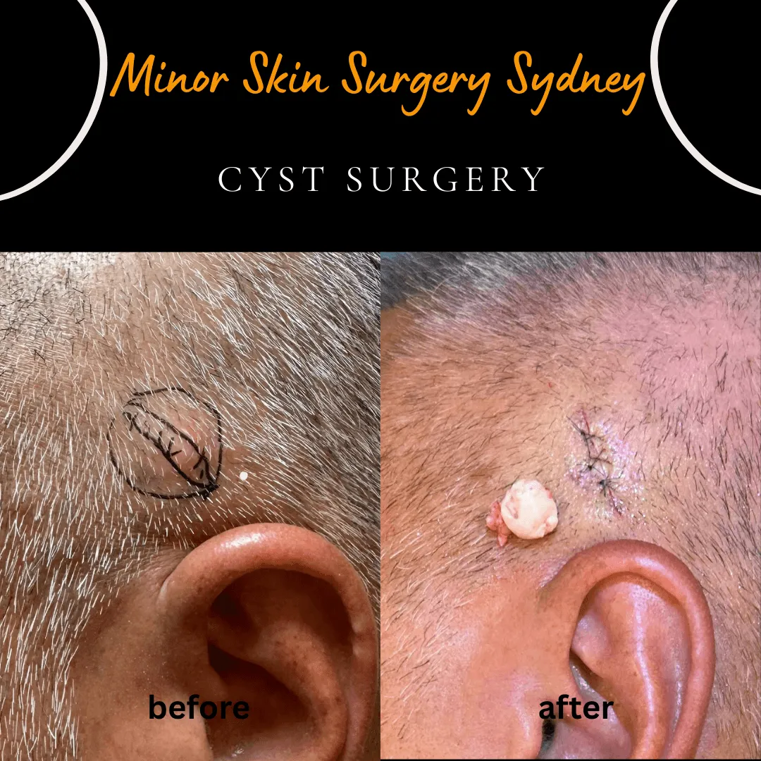 Same-day surgical removal of a small, recently enlarging scalp cyst under local anaesthesia, performed by Dr Peter Kim.