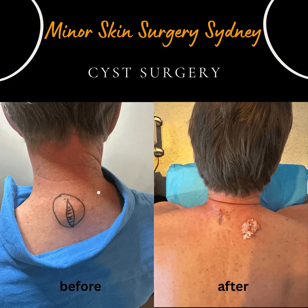 Same-day surgical removal of a gradually growing neck cyst, performed by Dr Peter Kim.