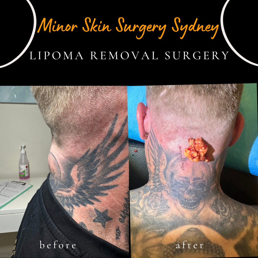 Same-day surgical removal of a neck lipoma causing restricted neck movement, performed under local anaesthesia by Dr Peter Kim.