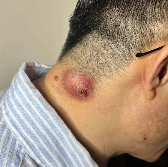 Infected cyst on the neck that burst and became infected, before formal drainage and later removal of the cyst sac