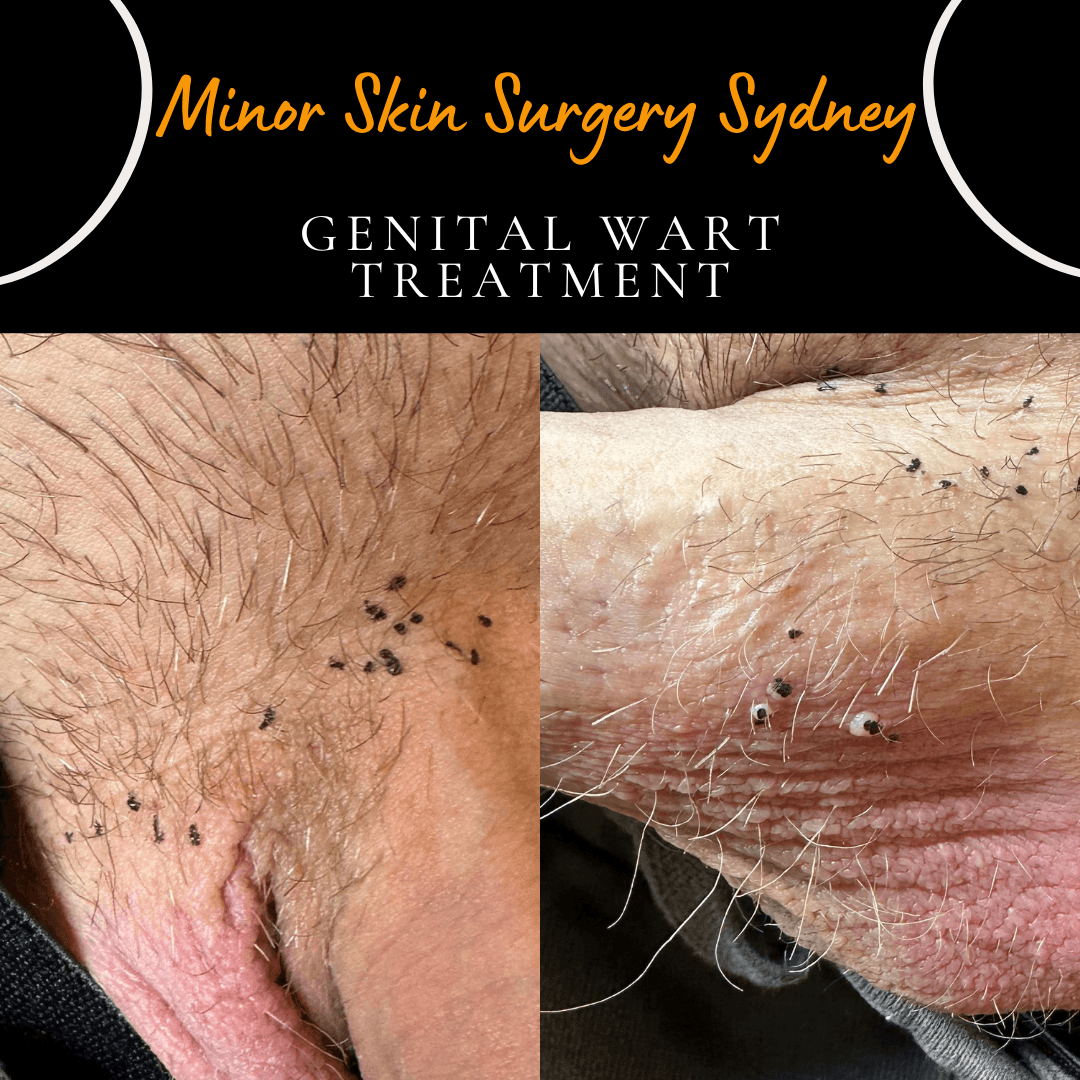 Laser treatment of multiple small genital warts before they enlarge further, performed by Dr Peter Kim.