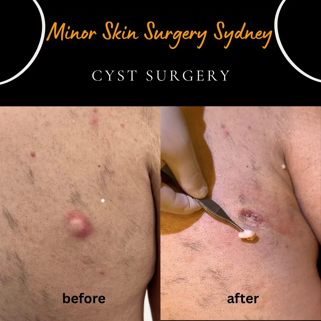 Chest cyst that is not yet infected but about to form an abscess, before early removal