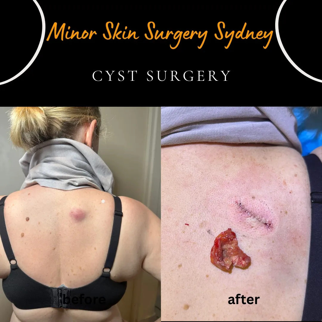 Cyst that burst internally causing redness without discharge, before the next stage of pus discharge and abscess