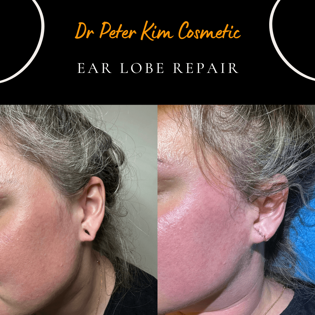 Same-day surgical repair of a torn earlobe under local anaesthesia, performed by Dr Peter Kim.